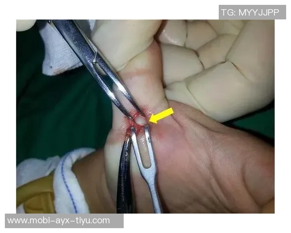 麦凯恩成功接受拇指韧带修复手术预计缺阵至少一个月